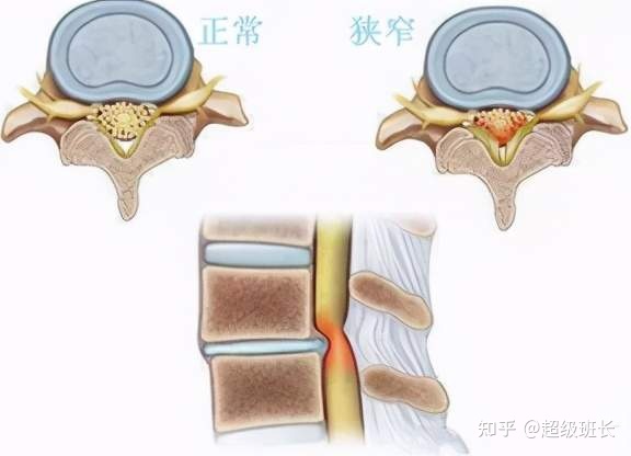 腰椎管狹窄手術(shù)成功率高嗎？都是怎樣做的？
