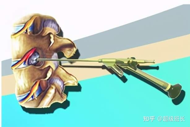 腰椎管狹窄手術(shù)成功率高嗎？都是怎樣做的？