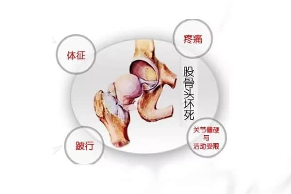 股骨頭壞死五大疑問，你真的都懂了么？