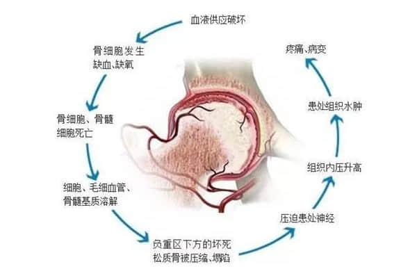 股骨頭壞死后股骨頭變形、塌陷怎么辦？