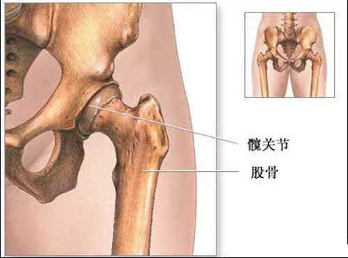 蓮池骨科醫(yī)院-股骨頭壞死患者，哪些情況下要做置換手術(shù)了？