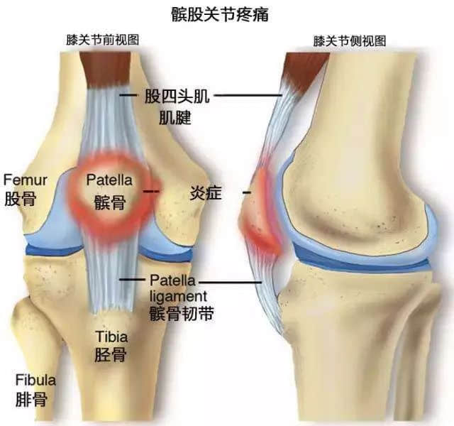 蓮池骨科醫(yī)院-髕骨疼痛綜合和跑步膝是什么關(guān)系