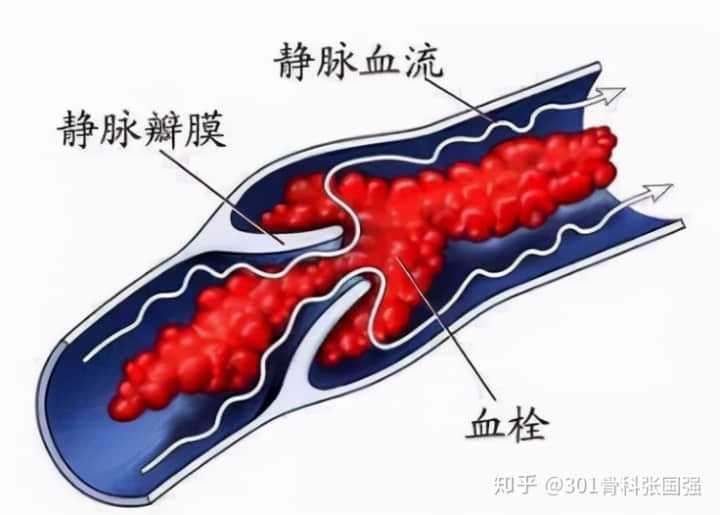 年齡「越大」，膝關(guān)節(jié)置換手術(shù)風(fēng)險「越高」嗎？