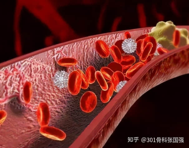 年齡「越大」，膝關(guān)節(jié)置換手術(shù)風(fēng)險「越高」嗎？