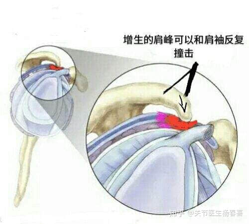 肩袖損傷與肩周炎可以用關(guān)節(jié)鏡治療嗎？