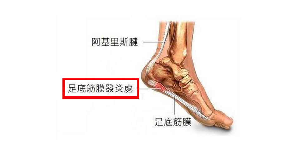 哪些人或者哪些習(xí)慣 容易患足底筋膜炎？