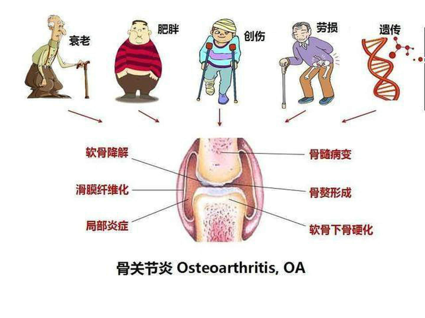 退行性骨關(guān)節(jié)炎怎么治