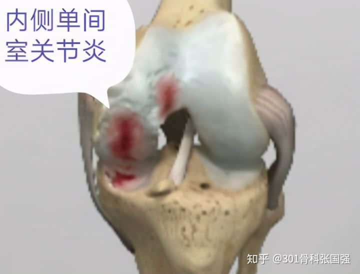 只有膝關節(jié)內側疼也要換膝關節(jié)嗎？