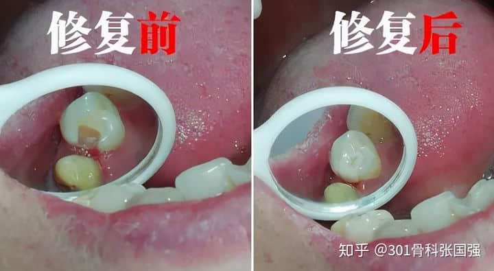 只有膝關節(jié)內側疼也要換膝關節(jié)嗎？