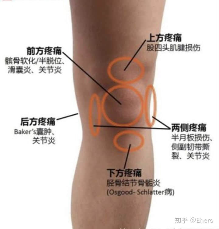 膝蓋積液是怎么回事？如何預(yù)防或消除