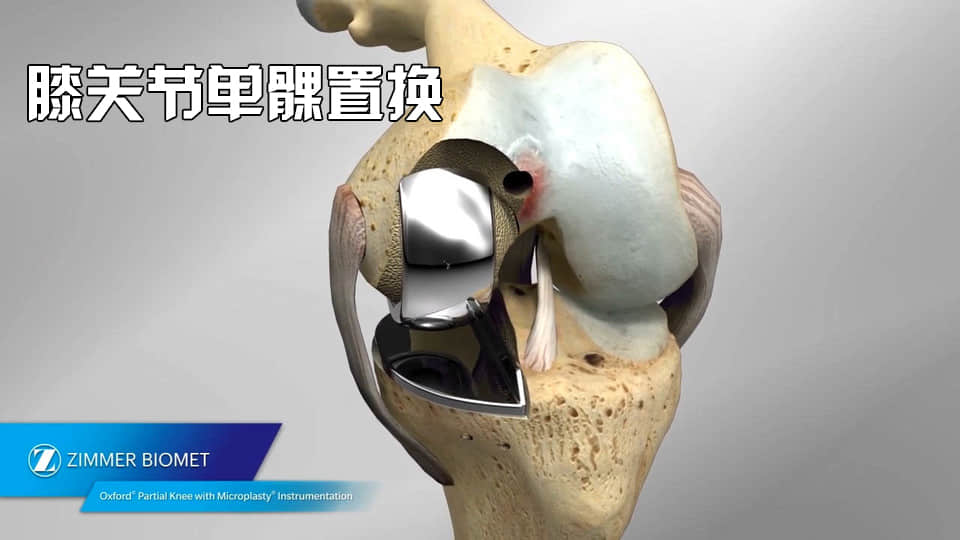 膝蓋疼醫(yī)生建議換一半關(guān)節(jié)