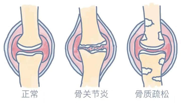 膝骨關(guān)節(jié)炎是一種老年常見(jiàn)病，多見(jiàn)于50歲以上人群，是引起老年人疼痛和殘疾的主要原因，常導(dǎo)致患者生活質(zhì)量下降。在門診中，我們經(jīng)常會(huì)碰到這樣的患者或家屬，他們關(guān)切的問(wèn)道：這個(gè)病能根治嗎，需要怎么治療？可以看出很多人對(duì)這一疾病還缺乏基本的認(rèn)知。

下面，我們來(lái)全面認(rèn)識(shí)下什么是膝骨關(guān)節(jié)炎。

★膝骨關(guān)節(jié)炎的概念★

膝骨關(guān)節(jié)炎還有一種說(shuō)法叫膝關(guān)節(jié)退行性變，通俗點(diǎn)說(shuō)就是關(guān)節(jié)老化了，這種老化的根源是關(guān)節(jié)軟骨的老化。

正常膝關(guān)節(jié)表面都有一層厚度約為3-5mm的軟骨，關(guān)節(jié)軟骨非常光滑，起到潤(rùn)滑、緩沖應(yīng)力的作用。

隨著年齡增長(zhǎng)軟骨會(huì)逐漸變薄，如果再伴有這些因素，比如：外傷，關(guān)節(jié)受力異常，韌帶或半月板損傷，先天發(fā)育不良，體重過(guò)大等，就會(huì)加速軟骨的磨損老化。

關(guān)節(jié)軟骨結(jié)構(gòu)的完整性非常重要，一旦損傷，會(huì)導(dǎo)致關(guān)節(jié)腫脹和疼痛，加速破壞，發(fā)展成骨關(guān)節(jié)炎。

由于關(guān)節(jié)軟骨中沒(méi)有血管，其營(yíng)養(yǎng)物質(zhì)依靠關(guān)節(jié)液供應(yīng)，其本身也不含可以分化再生的細(xì)胞，一旦損傷后很難自我修復(fù)或再生。

雖然近幾年來(lái)對(duì)于軟骨修復(fù)和軟骨再生的研究有了一些成果，但現(xiàn)階段來(lái)看，對(duì)于老年骨關(guān)節(jié)炎的軟骨再生是不可能的。








圖：左側(cè)為健康的膝關(guān)節(jié)（軟骨完整），右側(cè)為骨關(guān)節(jié)炎的膝關(guān)節(jié)炎（軟骨破壞）

所以說(shuō)膝骨關(guān)節(jié)炎是不可能治愈的，但是對(duì)于不同嚴(yán)重程度的膝骨關(guān)節(jié)炎，通過(guò)正確有效的治療，可以緩解或消除疼痛，延緩關(guān)節(jié)老化速度，改善或恢復(fù)關(guān)節(jié)功能，提高患者的生活質(zhì)量，實(shí)現(xiàn)臨床治愈。

那么該如何正確有效的治療呢？

★膝骨關(guān)節(jié)炎的治療★

膝骨關(guān)節(jié)炎可根據(jù)疼痛及對(duì)日?；顒?dòng)的影響程度分為初期、早期、中期和晚期，針對(duì)不同分期，有不同的治療策略。








中華醫(yī)學(xué)會(huì)《骨關(guān)節(jié)炎診療指南》2018 年版，針對(duì)不同分期的膝骨關(guān)節(jié)炎提出基礎(chǔ)治療、藥物治療、修復(fù)性治療和重建治療四層次的金字塔型的階梯治療策略。

基礎(chǔ)治療
基礎(chǔ)治療包括：健康教育，運(yùn)動(dòng)治療，物理治療和行為支持治療。對(duì)癥狀較輕的初期患者這是首選的治療方式。強(qiáng)調(diào)改變生活及工作方式的重要性，使患者樹(shù)立正確的治療目標(biāo)，減輕疼痛、改善和維持關(guān)節(jié)功能，延緩疾病進(jìn)展。

藥物治療
按藥物使用途徑分為外用藥物、口服藥物、關(guān)節(jié)腔內(nèi)注射藥物等。

口服藥物：在使用口服藥物前，建議先選擇局部外用藥物，尤其是老年人，可使用各種NSAIDs類藥物的凝膠貼膏、乳膠劑、膏劑、貼劑等，如氟比洛芬凝膠貼膏、扶他林乳膏等?？诜幬镏凶畛Ｓ玫氖荖SAIDs類鎮(zhèn)痛藥，但要注意NSAIDs類藥物過(guò)量使用并不能增強(qiáng)療效、可能會(huì)增加毒副反應(yīng)。

關(guān)節(jié)腔注射藥物：對(duì)早中期可緩解疼痛，改善關(guān)節(jié)功能，但該方法是侵入性治療，可能會(huì)增加感染的風(fēng)險(xiǎn)，必須嚴(yán)格無(wú)菌操作及規(guī)范操作，而且最新的國(guó)際指南并不推薦關(guān)節(jié)腔注射。

手術(shù)治療
修復(fù)性治療包括：關(guān)節(jié)鏡手術(shù)，關(guān)節(jié)軟骨修復(fù)術(shù)及生物治療，膝關(guān)節(jié)周圍截骨術(shù)。

關(guān)節(jié)鏡清理：主要針對(duì)伴有“膝關(guān)節(jié)卡頓”或半月板撕裂等癥狀的患者，通過(guò)關(guān)節(jié)鏡下摘除游離體、清理半月板碎片及增生的滑膜等，能減輕部分早中期患者的癥狀，但有研究認(rèn)為其遠(yuǎn)期療效與保守治療相當(dāng)，最新的國(guó)際指南也不推薦關(guān)節(jié)鏡手術(shù)作為癥狀性骨關(guān)節(jié)炎患者的治療手段。

關(guān)節(jié)軟骨修復(fù)術(shù)及生物治療:療效尚需進(jìn)一步研究探索。

膝關(guān)節(jié)周圍截骨術(shù)：是經(jīng)典的保膝治療手段，最常用的是脛骨高位截骨術(shù)（HTO）。該方法通過(guò)改變力線來(lái)改變關(guān)節(jié)面的接觸面，就像是一顆小樹(shù)長(zhǎng)歪了，我們通過(guò)外力把它變直。該方法可以有效緩解甚至消除疼痛，大部分患者可不需再行關(guān)節(jié)置換。該方法適合青中年活動(dòng)量大、力線不佳的患者。


重建性手術(shù)：主要是人工關(guān)節(jié)置換術(shù)，包括膝關(guān)節(jié)部分置換術(shù)（單髁置換術(shù)）和全膝關(guān)節(jié)置換術(shù)。


單髁置換術(shù)：適用于當(dāng)膝關(guān)節(jié)的軟骨只有一個(gè)地方受累，而且關(guān)節(jié)韌帶功能完好的情況下。這是一種微創(chuàng)手術(shù)，該技術(shù)能盡可能保留正常的關(guān)節(jié)結(jié)構(gòu)，具有創(chuàng)傷小，恢復(fù)快，術(shù)后關(guān)節(jié)自我感覺(jué)好等優(yōu)點(diǎn)，十年優(yōu)良率在95%左右。但是當(dāng)關(guān)節(jié)軟骨多個(gè)部分或全部都受累時(shí)，單髁置換就不能解決問(wèn)題了。這時(shí)需要全膝關(guān)節(jié)置換。


全膝關(guān)節(jié)置換術(shù)：是針對(duì)終末期骨關(guān)節(jié)炎成熟且有效的治療方法，尤其是伴有各種嚴(yán)重畸形時(shí)，能非常有效的解除患者病痛，極大提高患者生活質(zhì)量。術(shù)后絕大多數(shù)患者遠(yuǎn)期效果滿意，15-20年假體生存率可達(dá)90%。

結(jié)語(yǔ)
隨著人類壽命的延長(zhǎng)，人口老齡化，骨關(guān)節(jié)炎的發(fā)生率逐年增加，嚴(yán)重影響人們的生活質(zhì)量和健康，給社會(huì)造成巨大的經(jīng)濟(jì)負(fù)擔(dān)和壓力。所以，從年輕時(shí)我們就該引起重視，預(yù)防骨關(guān)節(jié)炎的發(fā)生。在出現(xiàn)癥狀的骨關(guān)節(jié)炎初期、早期，要正確認(rèn)識(shí)，通過(guò)積極的基礎(chǔ)治療和藥物治療，盡可能減緩病情進(jìn)展。

當(dāng)中晚期時(shí)，要根據(jù)病情、年齡、社會(huì)活動(dòng)的不同層次，以及關(guān)節(jié)間室累及情況，選擇合適的手術(shù)方案。特別是當(dāng)疼痛癥狀較重，嚴(yán)重影響生活質(zhì)量時(shí)，應(yīng)盡早進(jìn)行手術(shù)治療，而不是往后拖。