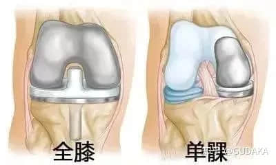 膝關(guān)節(jié)還能換半邊？UKA單髁置換是什么