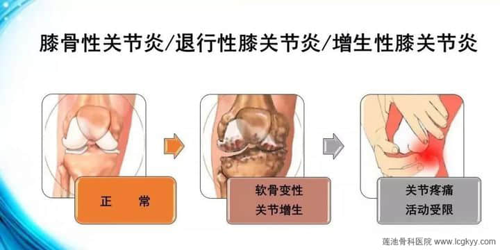 膝骨性關(guān)節(jié)炎，“保膝”“換膝”如何選？