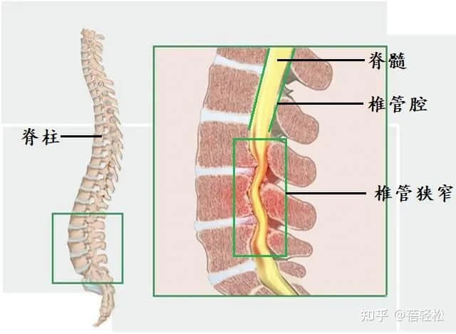 椎管狹窄是什么意思？嚴(yán)重嗎?
