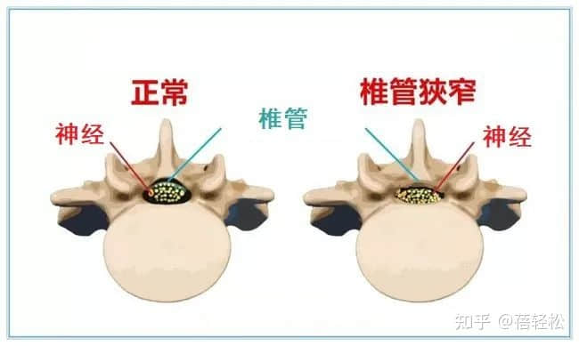 椎管狹窄是什么意思？嚴(yán)重嗎?