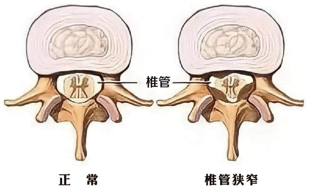 腰椎椎管狹窄癥？試試UBE技術！