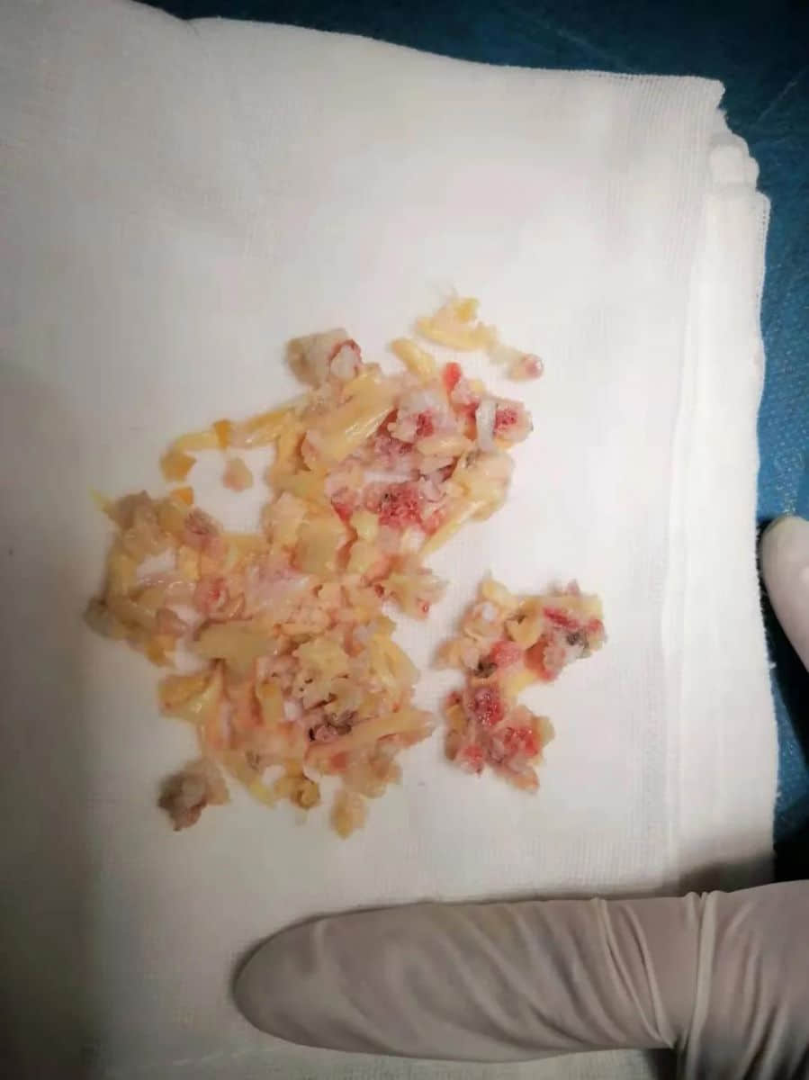 腰椎椎管狹窄癥？試試UBE技術！