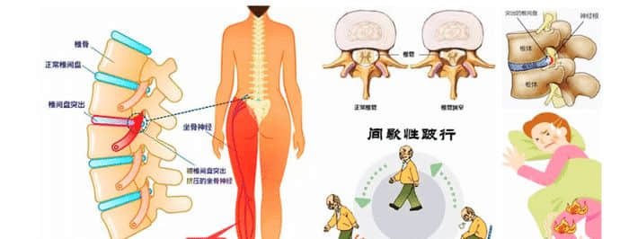 老年腰突癥與年輕患者有什么不同？哪些方法更適合？